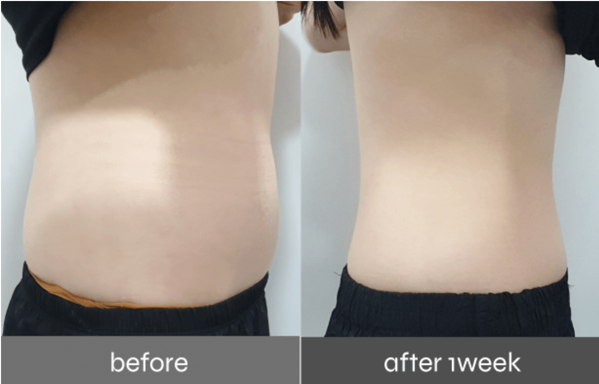 Before-and-after of Pladen 3rd Gen PPOPKKI for abdomen contouring