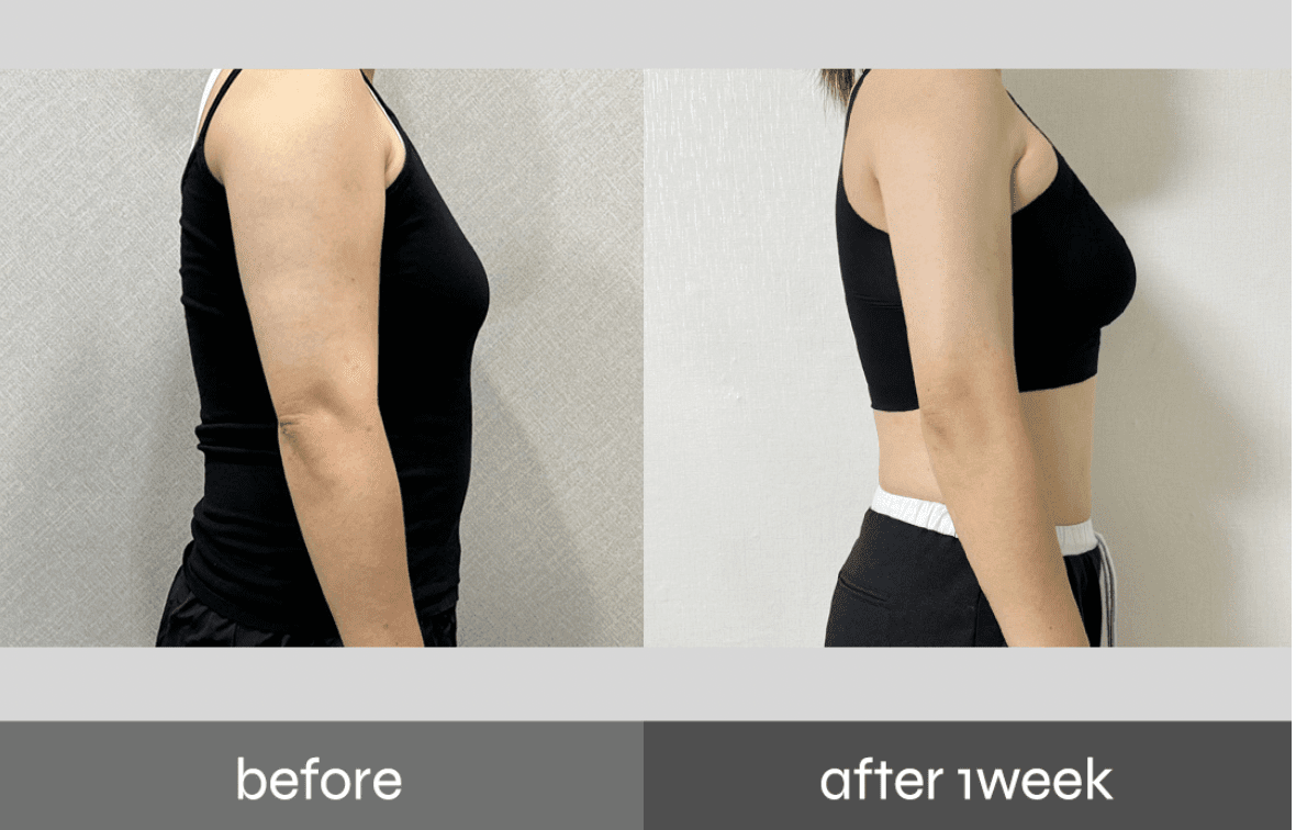 Before-and-after of Pladen 3rd Gen PPOPKKI for upper arm contouring