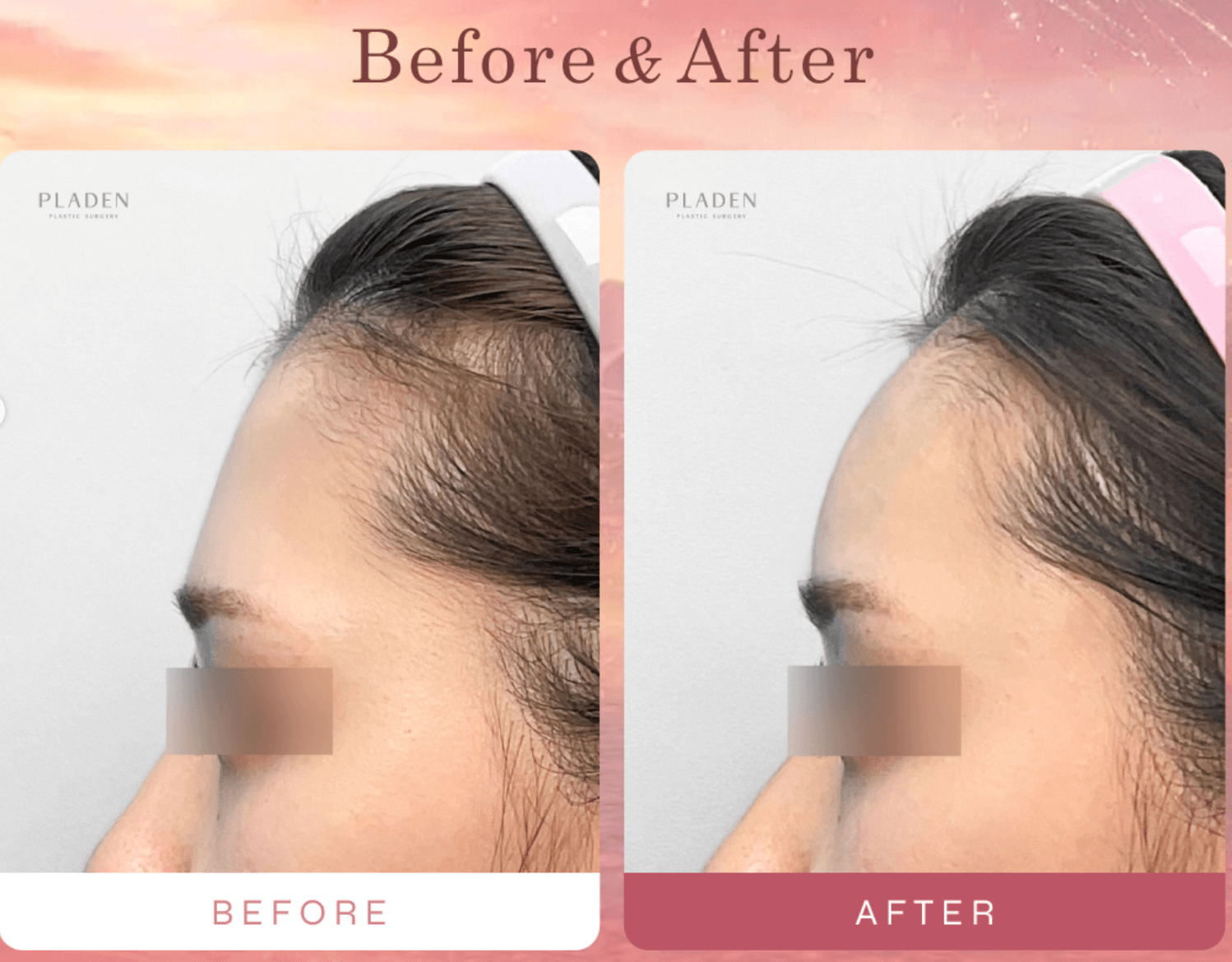 Before-and-after of Pladen forehead filler — bone-line architecture