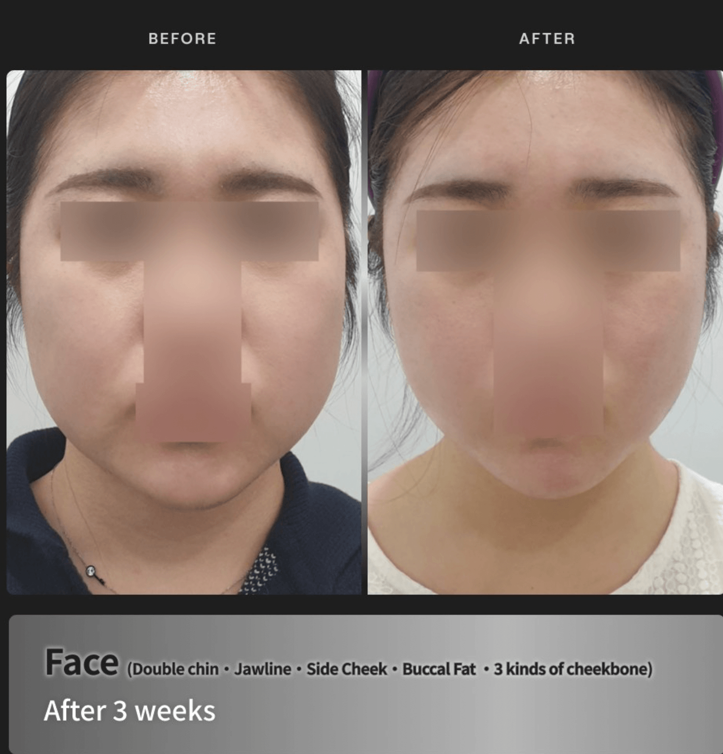 Before-and-after of Pladen Balance Filler full-face — Achromatic Beauty protocol