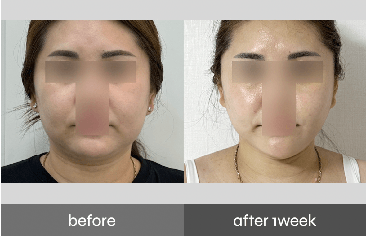 Before-and-after of Pladen PPOPKKI jawline contouring — non-surgical fat reduction