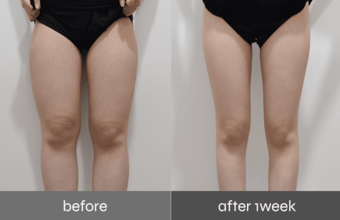 Before-and-after of Pladen 3rd Gen PPOPKKI for thigh and leg contouring