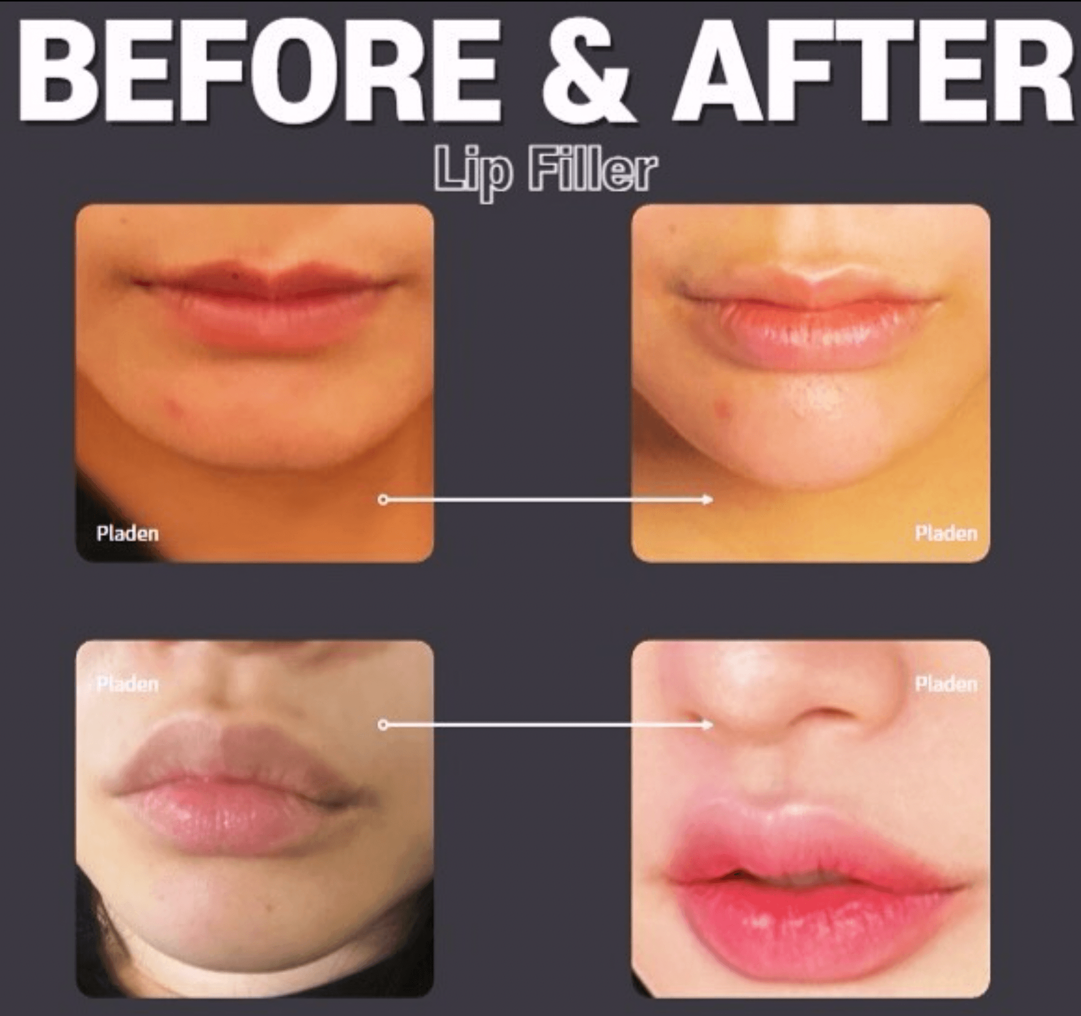 Before-and-after of Pladen lip filler procedure