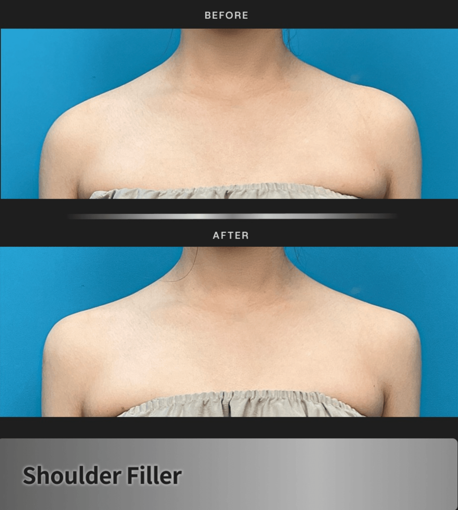 Before-and-after of Pladen shoulder filler procedure