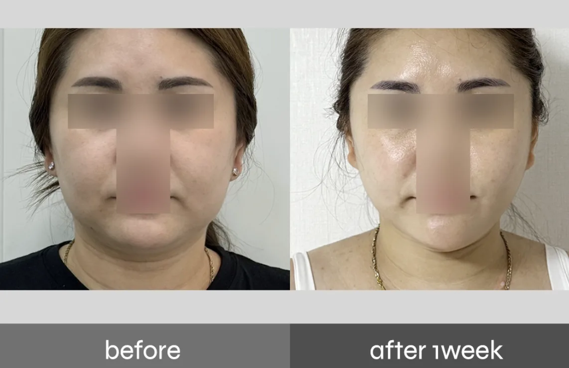 Pladen PPOPKKI (Extract) fat-dissolving injection before and after — facial fat reduction after one week